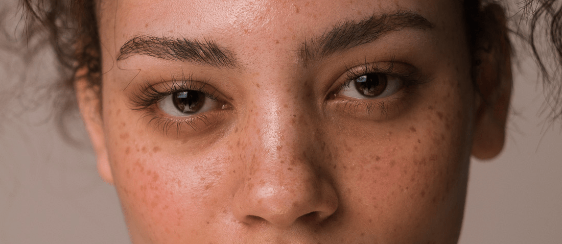 Sun Spots vs Freckles: What's The Difference?