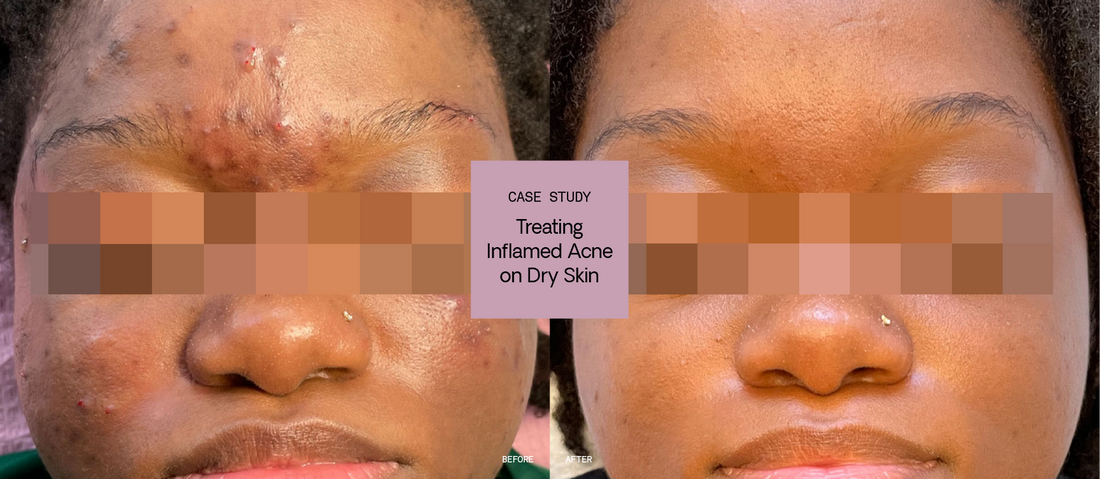 Treating Inflamed Acne on Dry, Sensitive Skin: Case Study