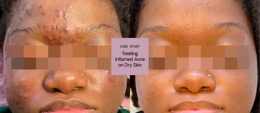 Treating Inflamed Acne on Dry, Sensitive Skin: Case Study