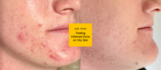 Treating Inflamed Acne on Oily Skin: Case Study