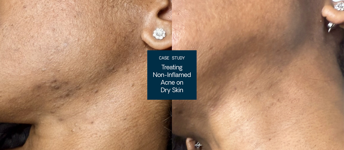 Treating Non-Inflamed Acne on Dry, Congested Skin: Case Study