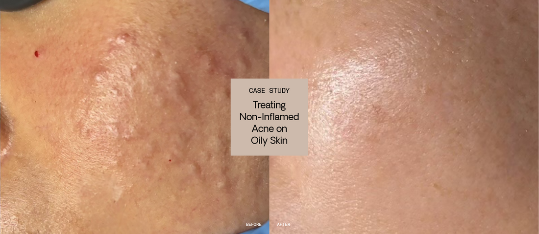 Treating Non-Inflamed Acne on Oily, Congested Skin: Case Study