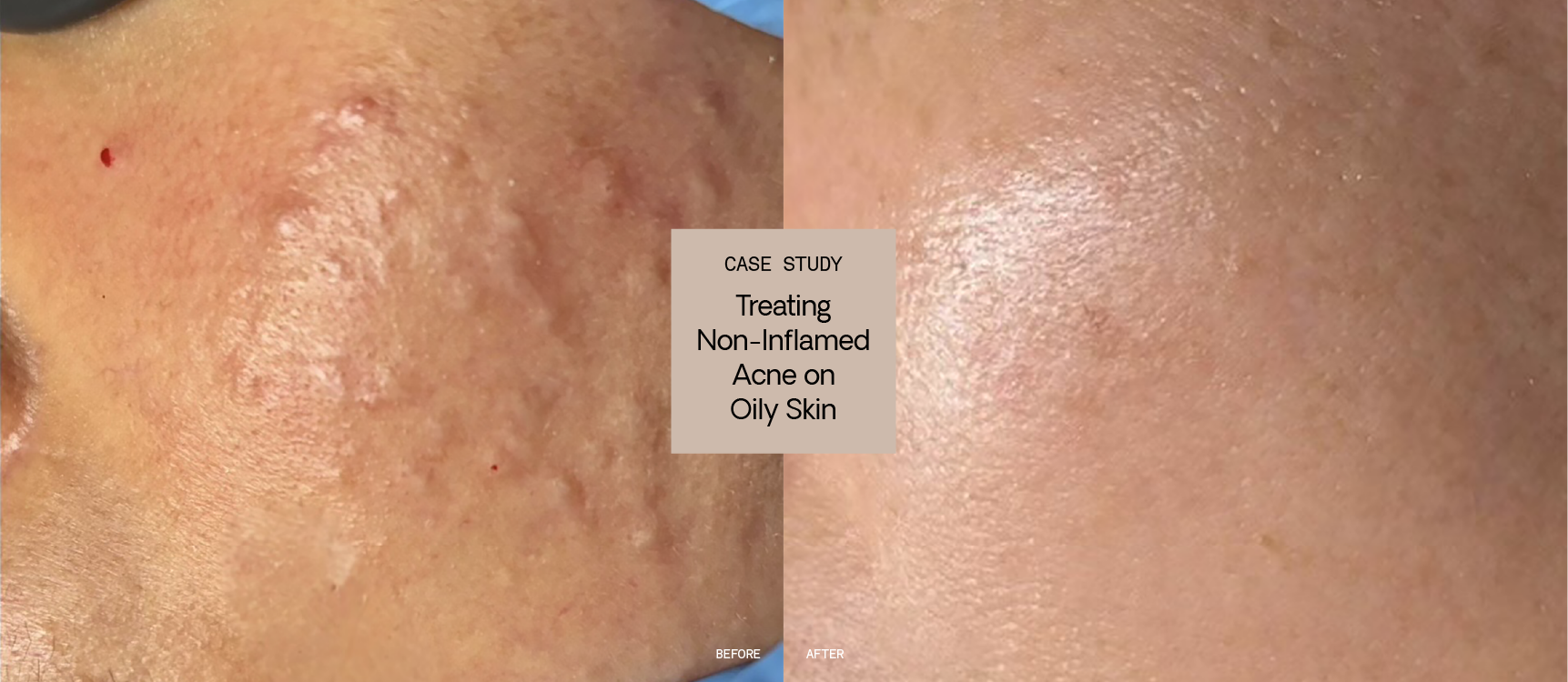 Treating Non-Inflamed Acne on Oily, Congested Skin: Case Study