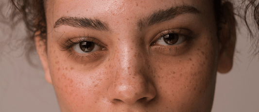 Sun Spots vs Freckles: What's The Difference?