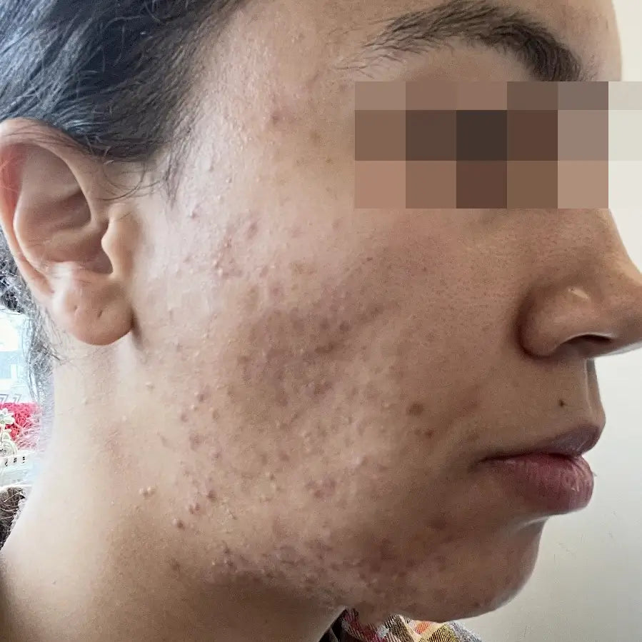 Non Inflamed Acne Types – SEVEN:THIRTY SKINCARE