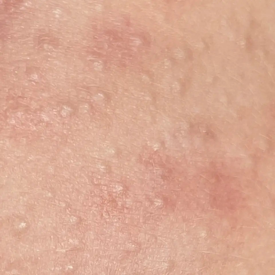 Non Inflamed Acne Types – SEVEN:THIRTY SKINCARE
