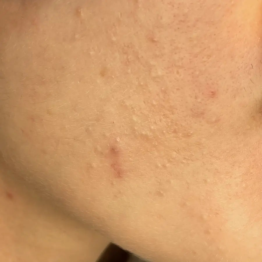 Non Inflamed Acne Types – SEVEN:THIRTY SKINCARE