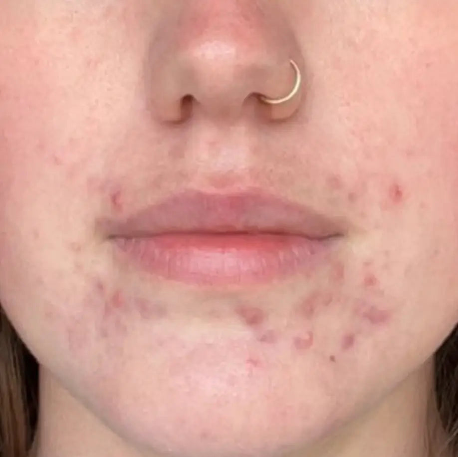 Non Inflamed Acne Types – SEVEN:THIRTY SKINCARE