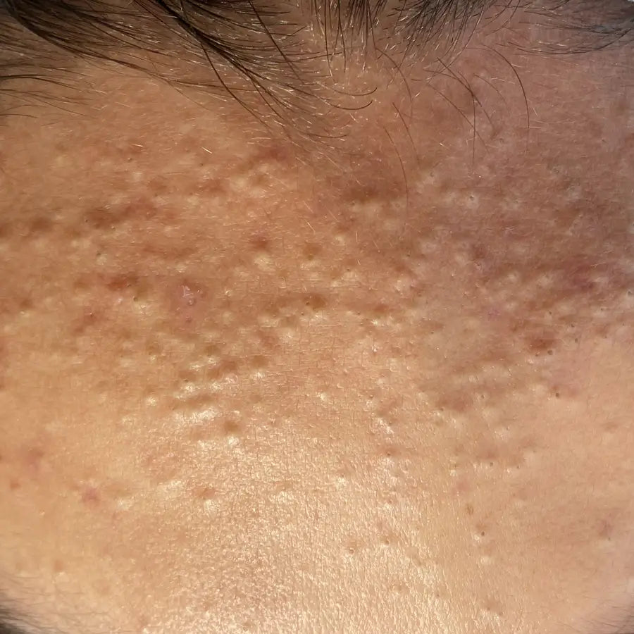 Non Inflamed Acne Types – SEVEN:THIRTY SKINCARE