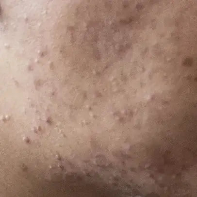 Non Inflamed Acne Types – SEVEN:THIRTY SKINCARE